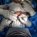 Hair Transplant